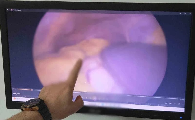 Samsun’da bağırsak kanseri tedavisi için hastaneye başvuran kişi, iç organlarının farklı yerlerde olduğunu öğrendi. 26 y