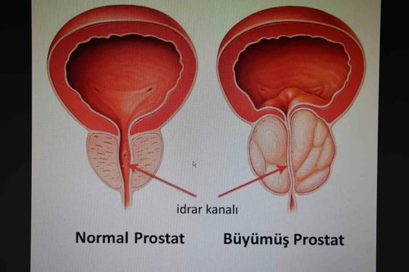 ELAZIĞ Medilines Hastanesi Üroloji Uzmanı Op. Dr. Veysel Yüzgeç, prostat kanseri hakkında değerlendirmelerde bulundu.