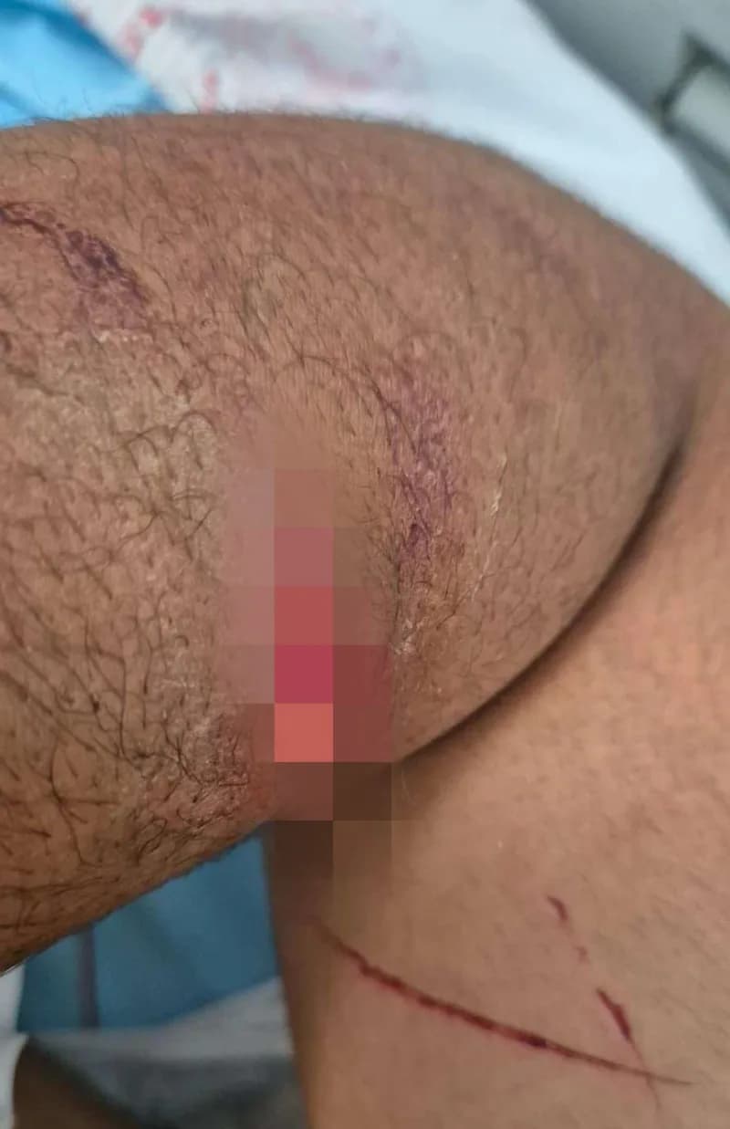 Antalya'da trafikte çıkan tartışmada bir genç, bıçaklanıp dalağını kaybetmişti