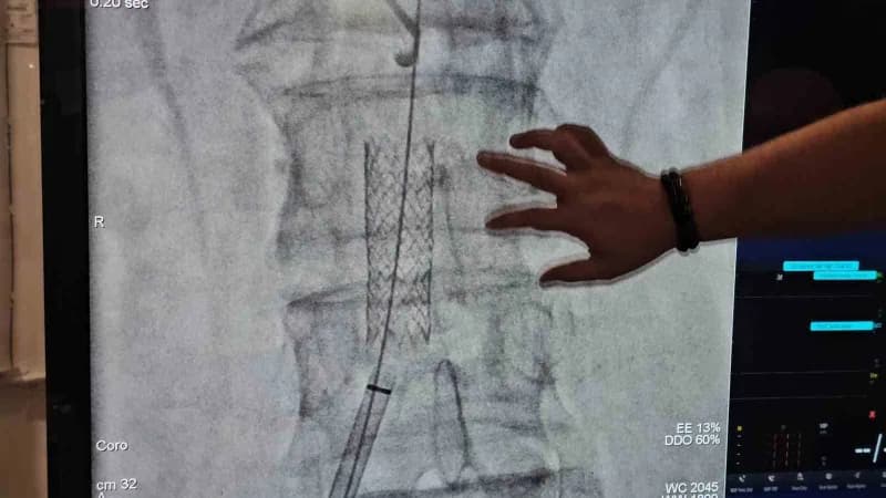 Zonguldak'ta yaklaşık bir yıldır bel, kalça ve bacak ağrıları nedeniyle yürümekte güçlük çeken 73 yaşındaki hastanın, vü