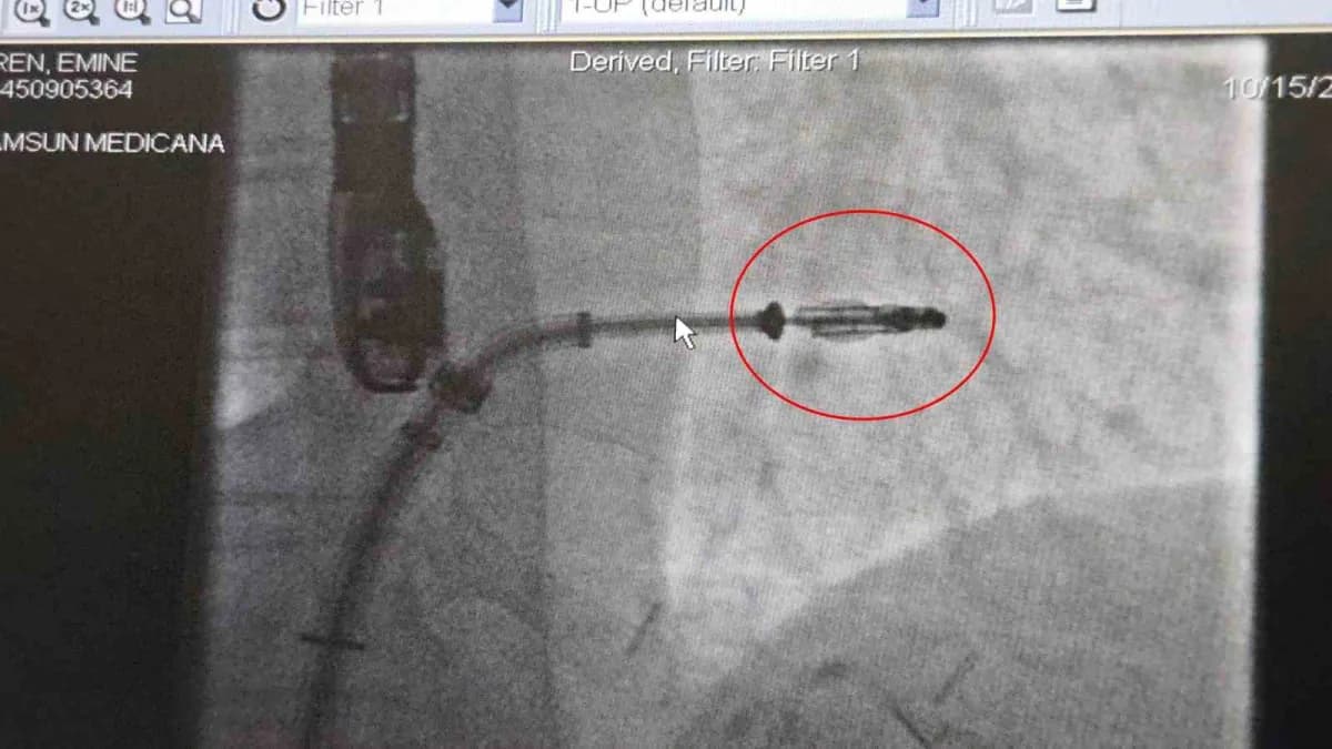Dr. Öğr. Üyesi Ahmet Yanık, açık kalp ameliyatı olması yüksek risk taşıyan veya ileri yaştaki hastalar için geliştirilen