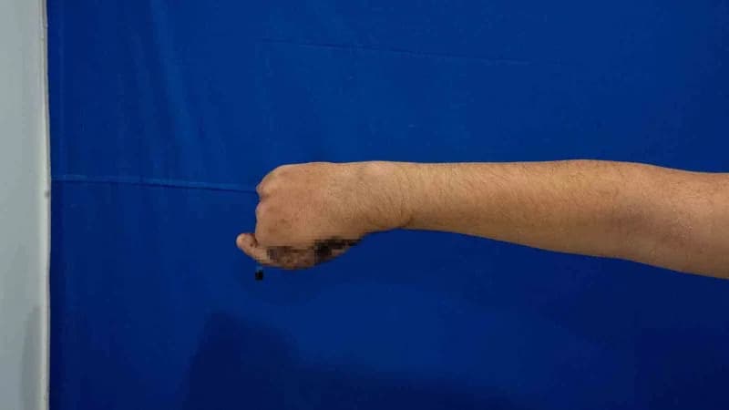Ayağından parmak nakli yapılan 13 yaşındaki Baran Tanzi ameliyat sonrası tedavi görüyor