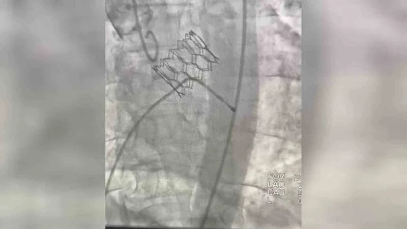 Aydın’ın Nazilli ilçesinde yaşayan 75 yaşındaki Mehmet g.’nin ciddi Aort Kapak darlığı, Denizli Özel